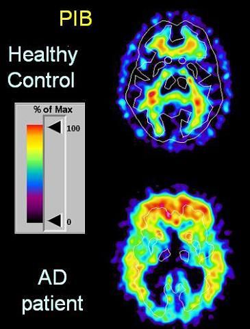 pm_Alzheimer