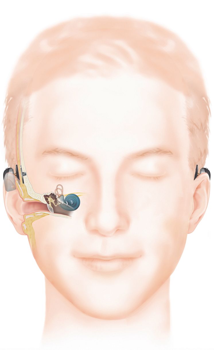 Wie das Hören mit einem Baha Knochenleitungsimplantat (Attract) funktioniert
