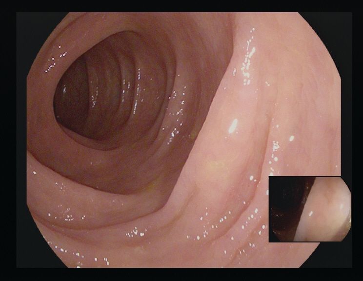 Innenansicht eines sauber gespülten Darms während der Koloskopie