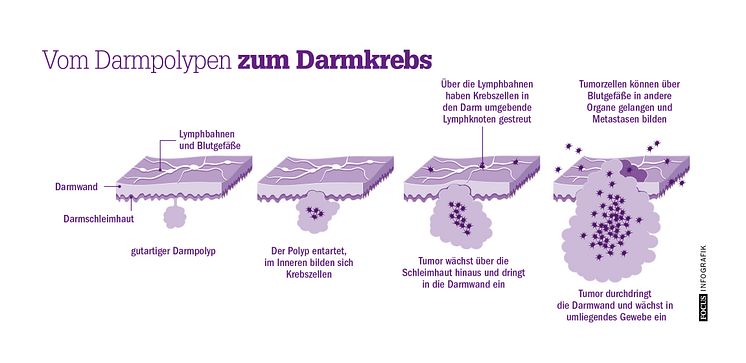 Vom Polypen zum Darmkrebs. 