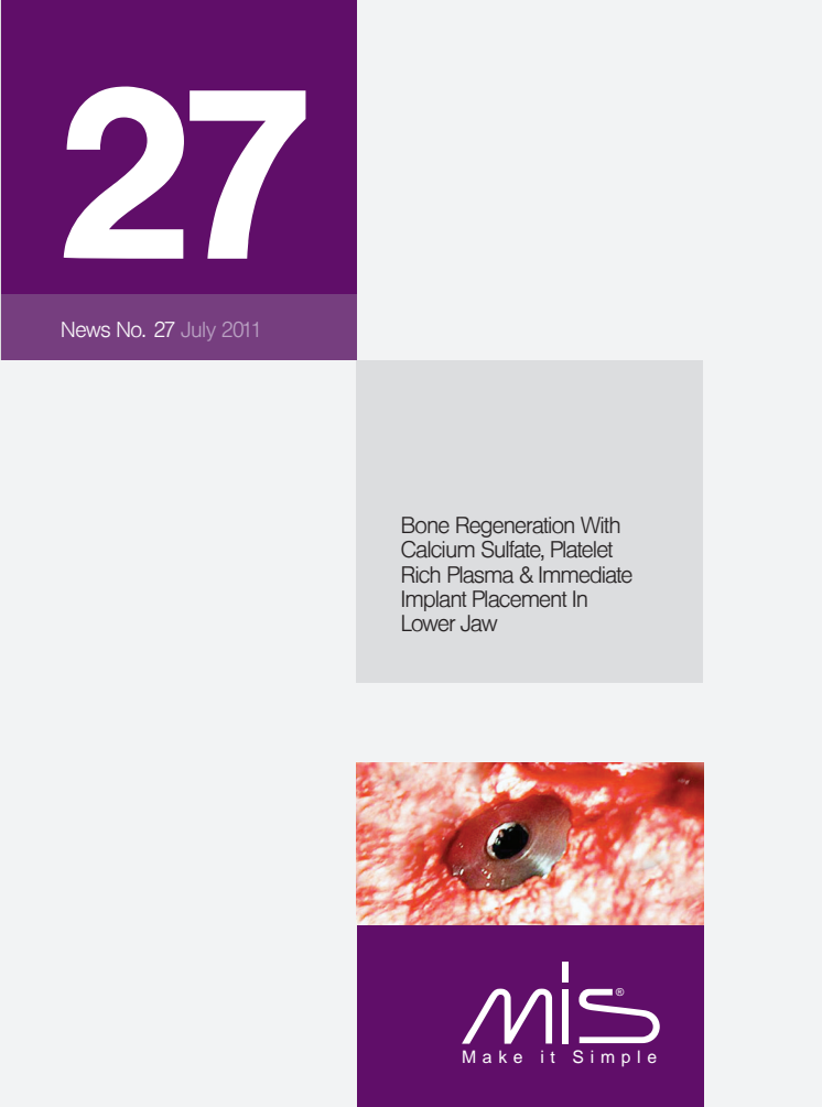 Bone Regeneration With Calcium sulfate Platelet Rich Plasma & Immediate Implant Placement in Lower Jaw