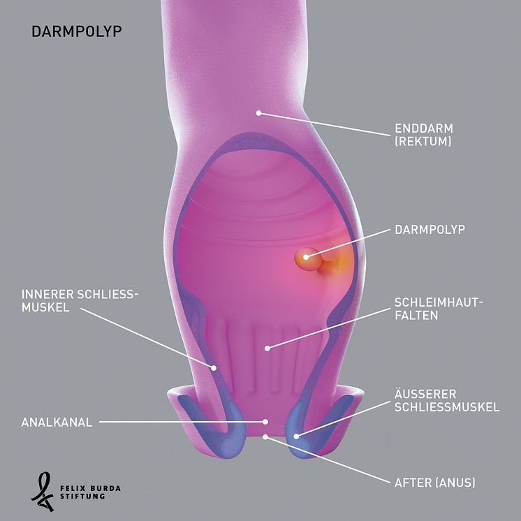 Anfangs ganz harmlos: Ein Darmpolyp