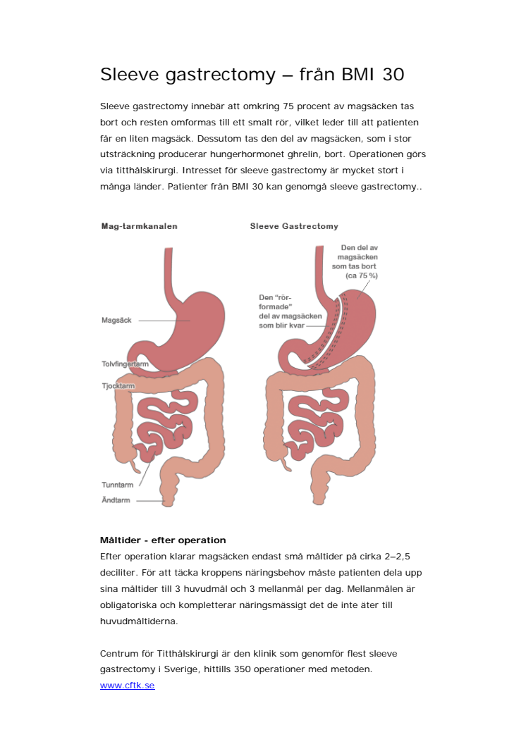 Fakta om sleeve gastrectomy