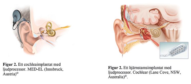 Cochleaimplantat och ABI-implantat