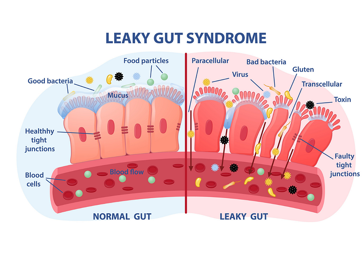 theorie_lipoedem_durch_leaky_gut_syndrom_beguenstigt