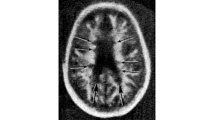 standing brain Young-MRI-MS-1981_fig5