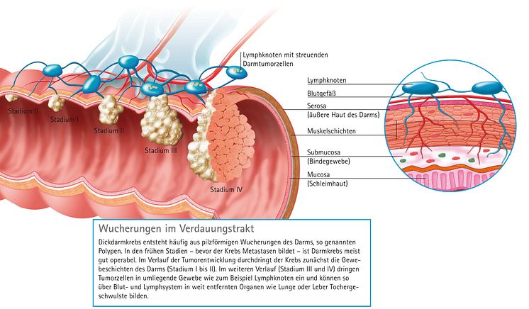 Entstehung von Darmkrebs/Wucherungen im Darm