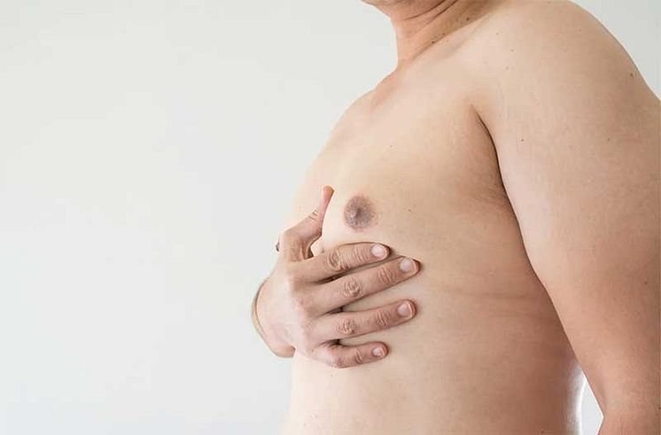 Gynecomastia-Singapore-Enlarged-Male-Breasts