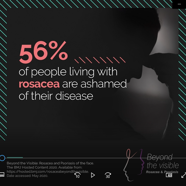 56% av personer som lever med rosacea skäms över sin åkomma.