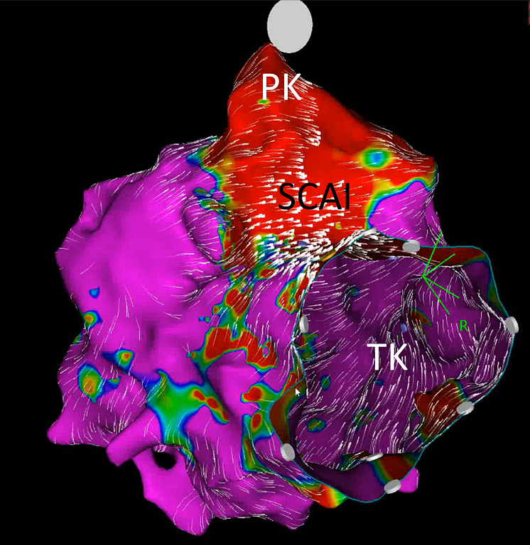 Elektroanatomische Karte (EAM) eines SCAI  