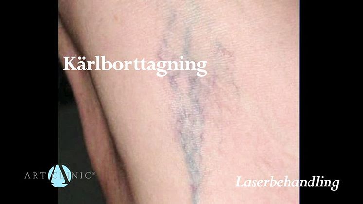 Laserbehandling på Art Clinic