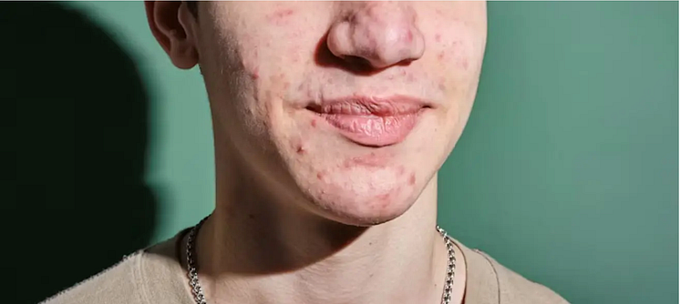 Acne Vulgaris.png