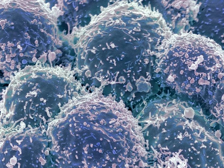 JJ_Photo_Lung cancer cells_GettyImages_172594320_1Star.jpg