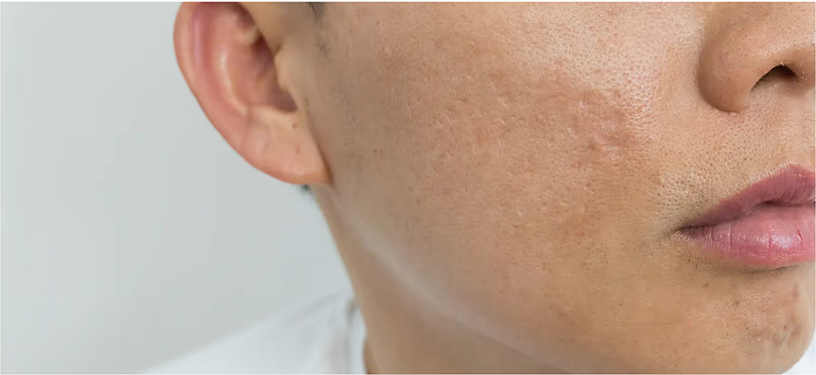 Type Of Skin Conditions Pico Fractional Laser Can Address.png