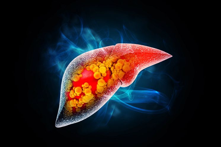 AdobeStock_96736795_hepatic steatosis1.jpeg