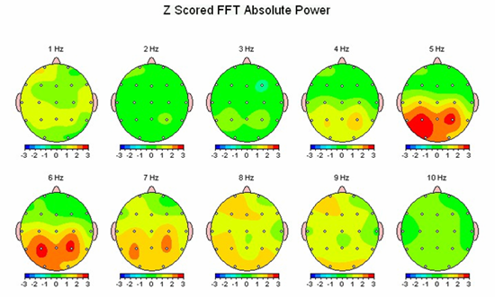 neurofeedback-depression.png