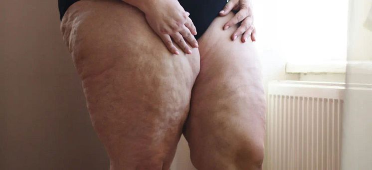 lipedema-singaporeans-fat-legs-1.webp