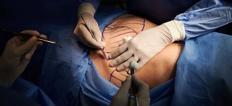 liposuction.webp
