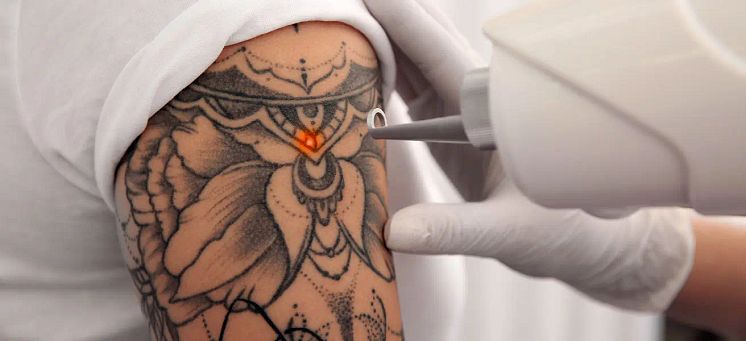 tattoo-removal-laser.webp