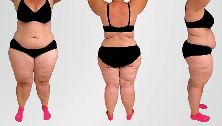 lipodem.jpg
