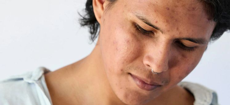 67dd12f29088db6864388955_hyperpigmentation.webp