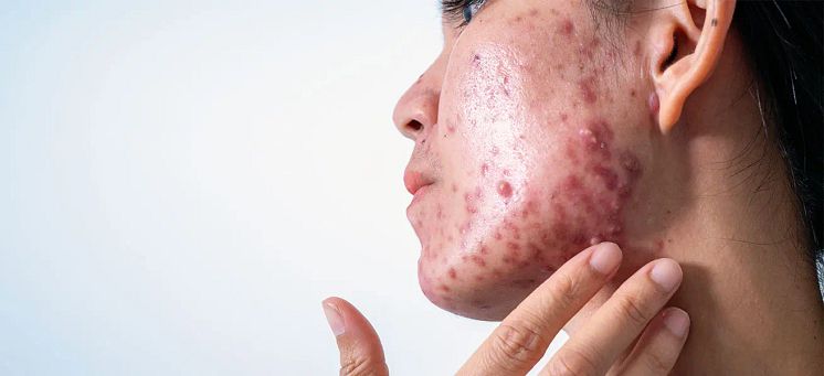 identify-acne.webp